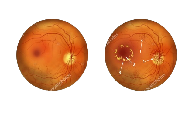 Retina fundus image showing eye health assessment